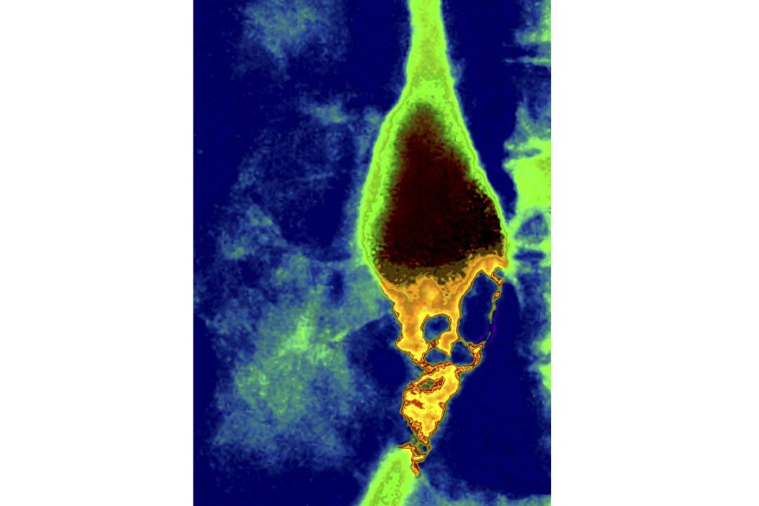 Imagen de Rayos X de un cáncer de esófago