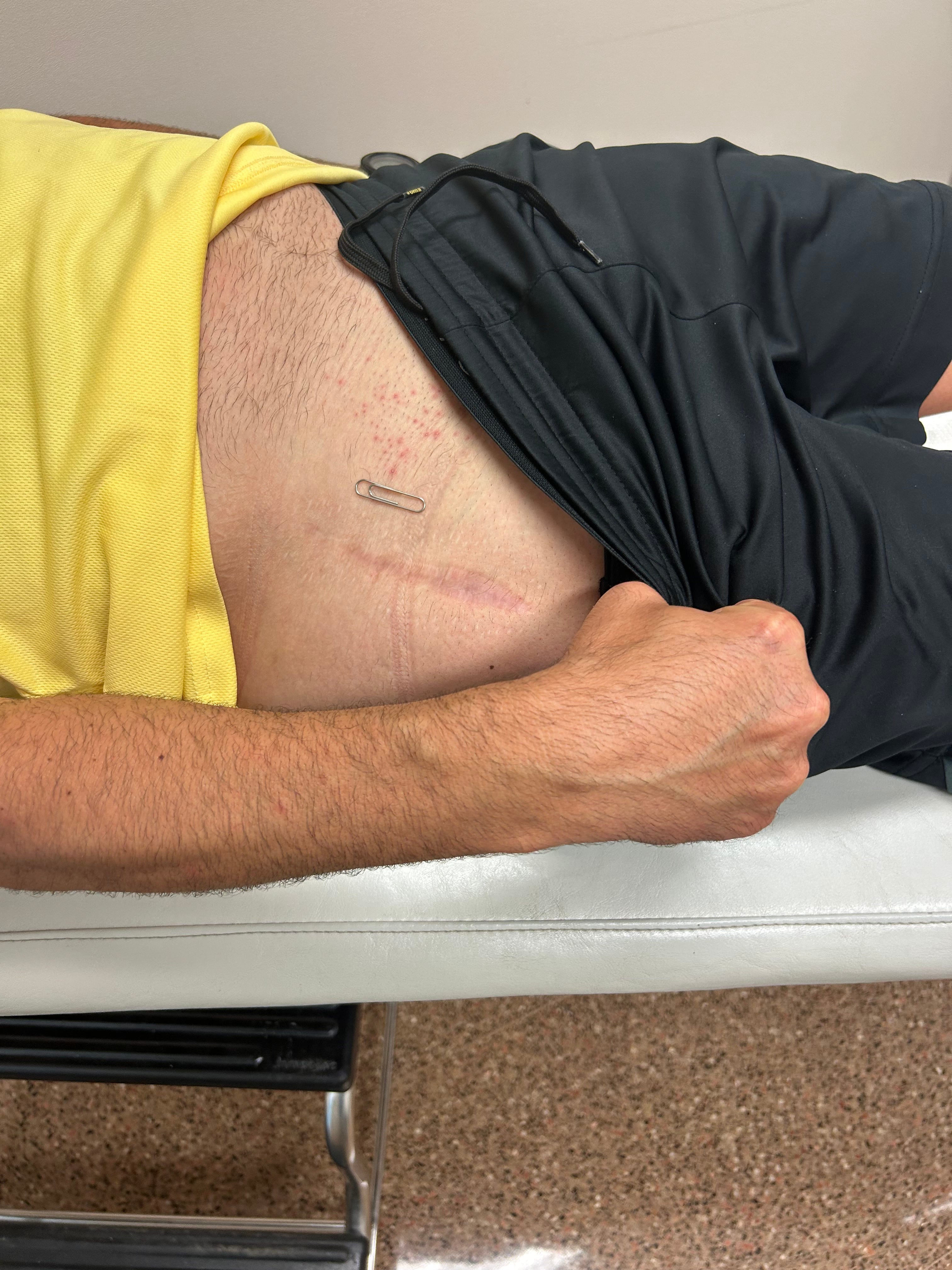 Cicatriz tras una operación de cadera