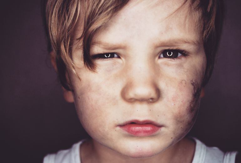 Niño con problemas faciales en la piel