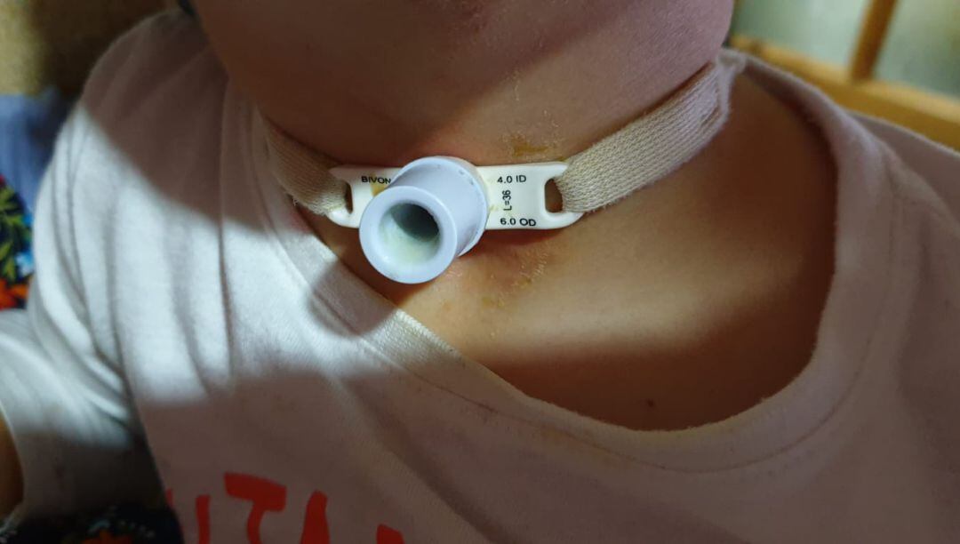 Gabriel, de 3 años, sufre una traqueostomía desde que tenía 21 días 