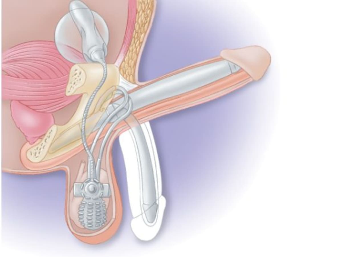 El último recurso para superar la disfunción eréctil