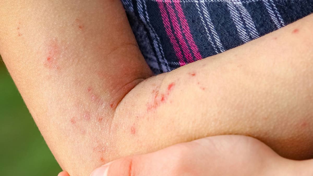 La Junta registra un caso de viruela del mono en un varón de Soria