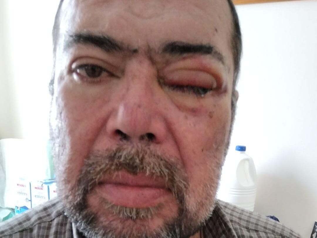 Carlos Almenara ha perdido la visión de un ojo tras tropezar en una calle mal iluminada de Telde (Gran Canaria)