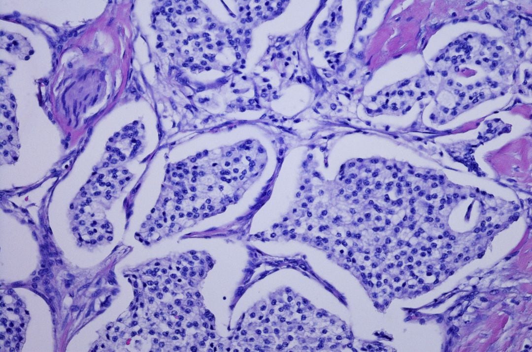 Micrografía de tumor neuroendocrino pancreático.