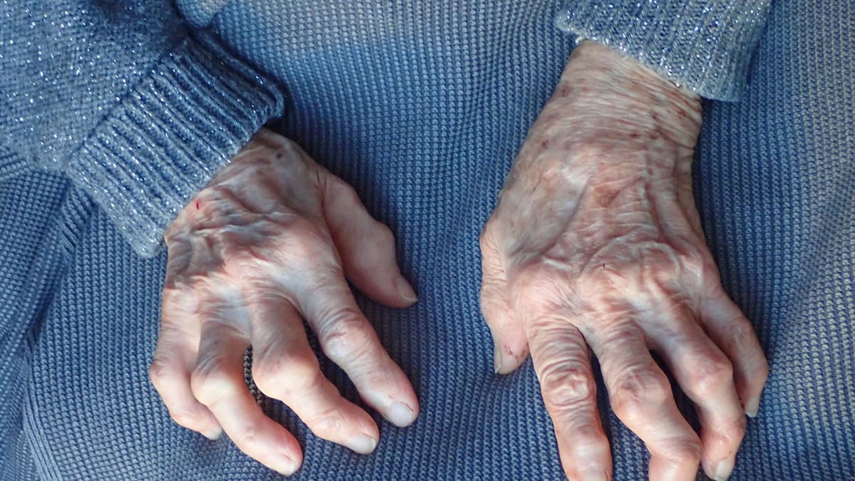 Científicos de Stanford descubren un posible tratamiento para la artritis