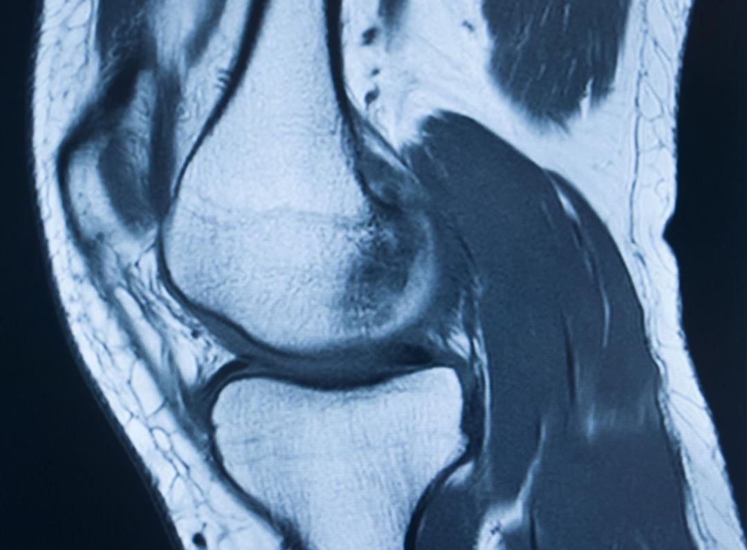 Imagen Médica De Articulación De Rodilla