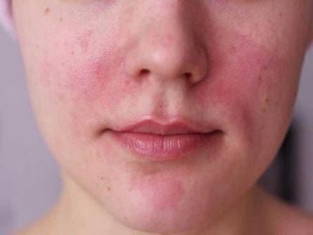 Dermatitis por contacto con mascarilla