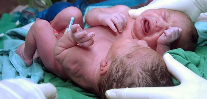 No se sabe si las niñas serán separadas, lo que en todo caso tendría que ser en el exterior porque en los hospitales hondureños no se cuenta con los medios