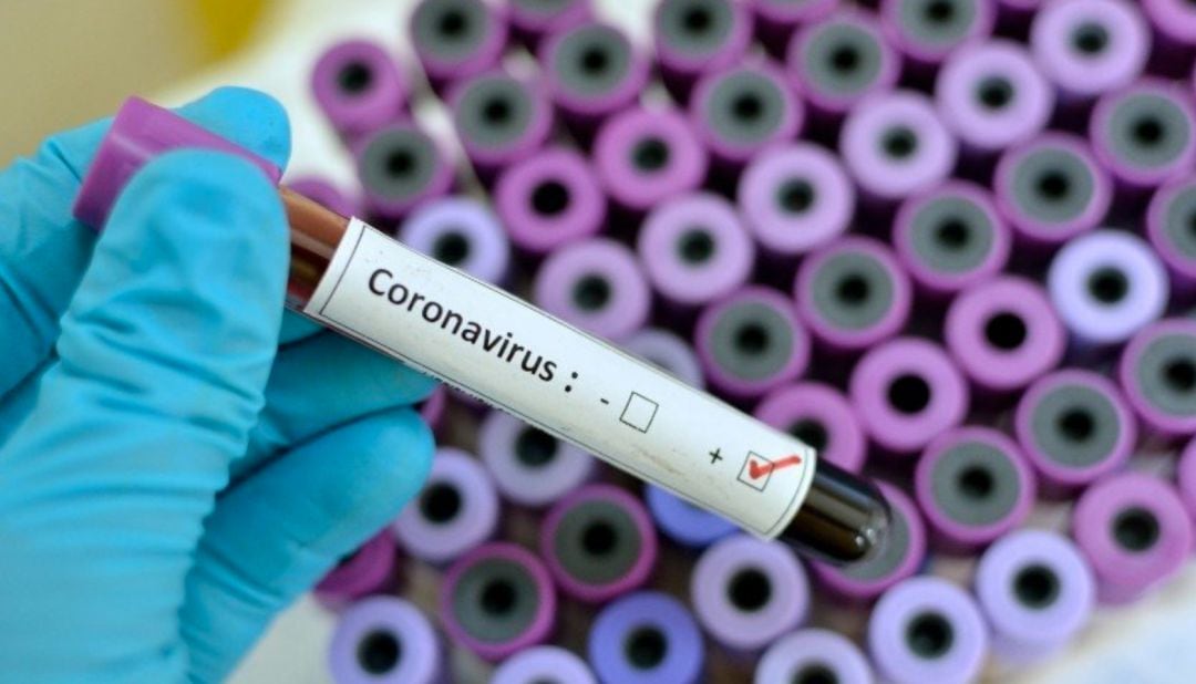 Muestra de un análisis de coronavirus