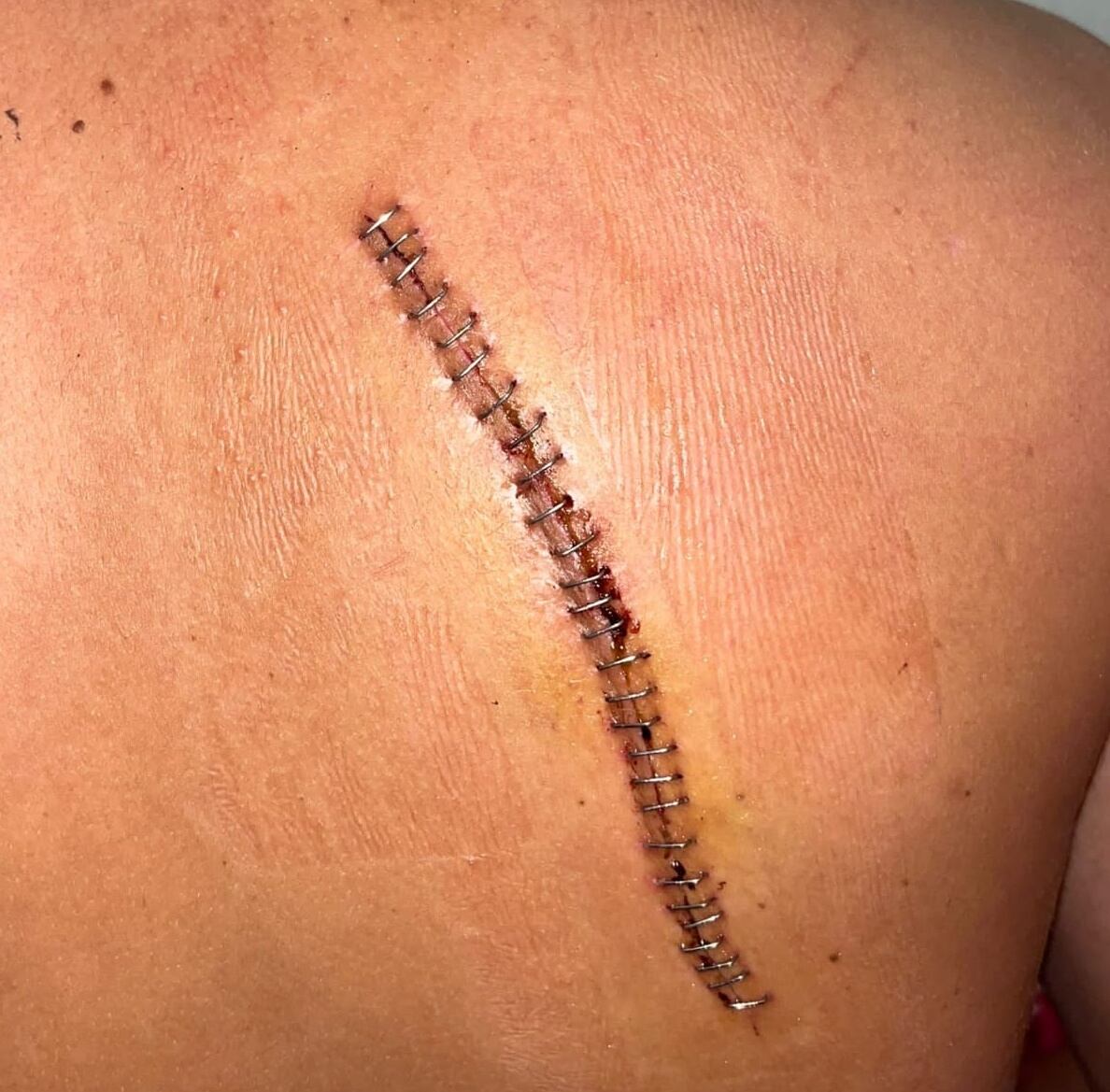 Al joven tuvieron que operarle de urgencia e hicieron falta 80 puntos de sutura interna y externa