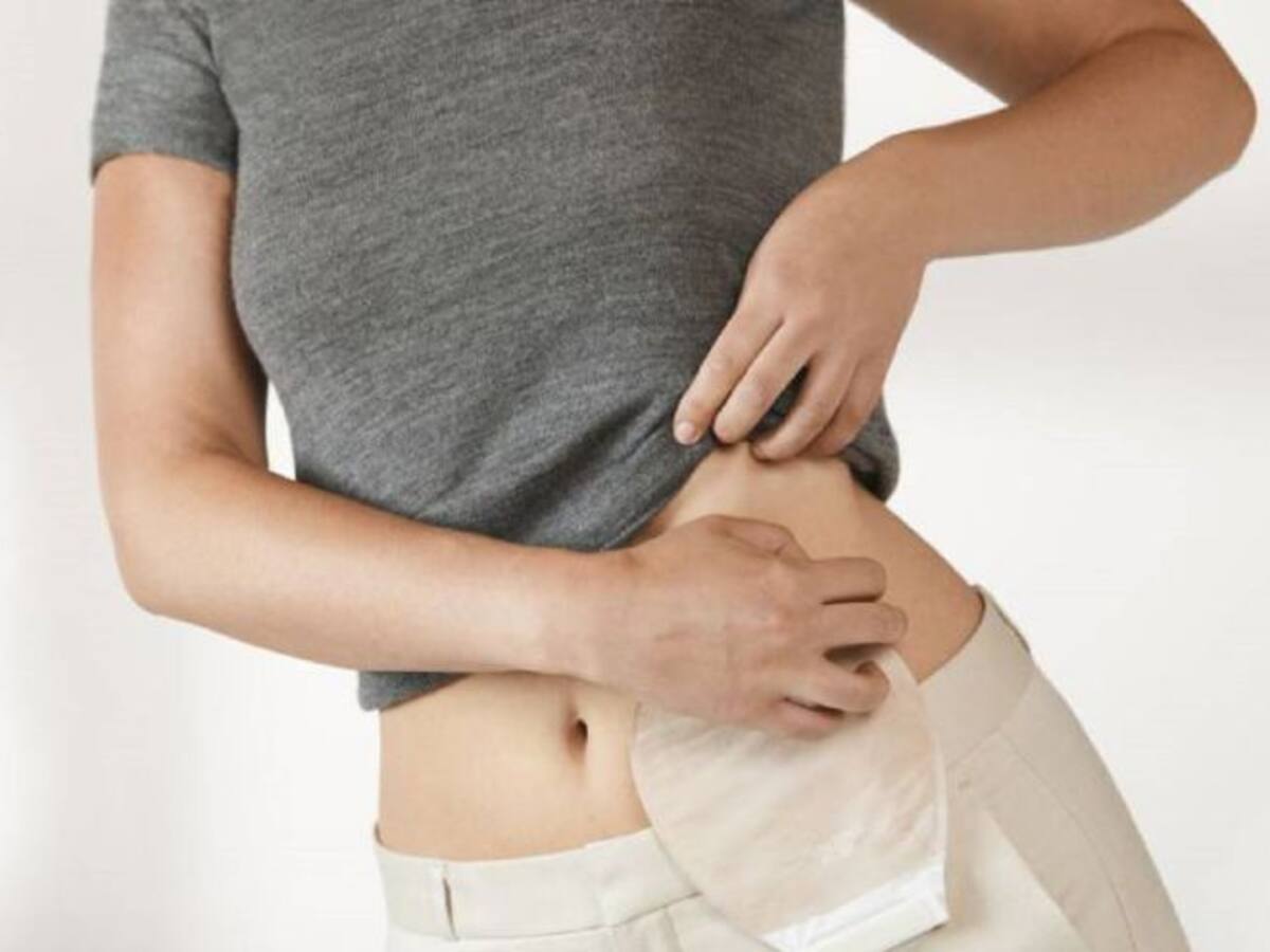 El Hospital de Palencia acogerá la primera exposición itinerante sobre ostomía