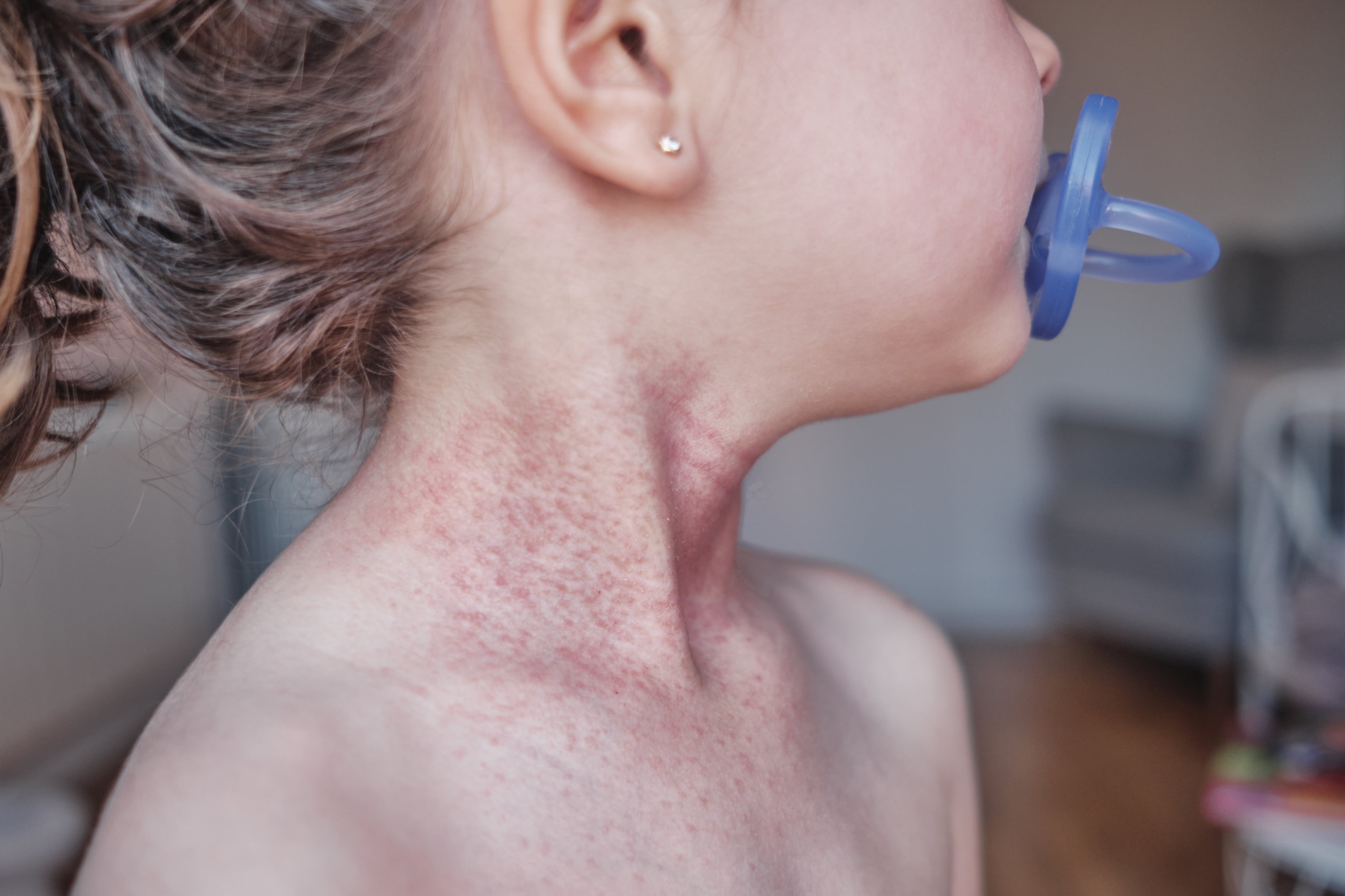 Una niña afectada por dermatitis atópica