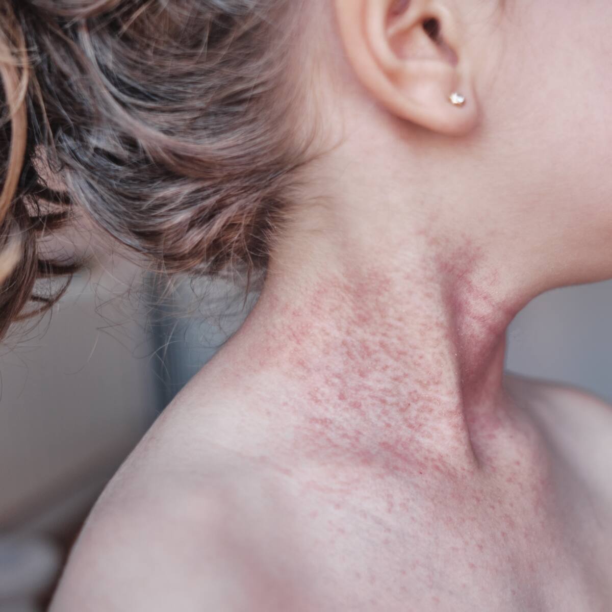 Preguntas y respuestas sobre la dermatitis atópica infantil