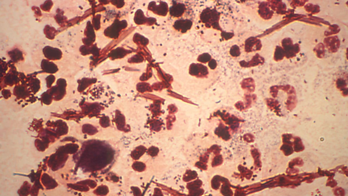 Un nuevo medicamento oral de dosis única cura la gonorrea a casi 900 pacientes en un ensayo clínico