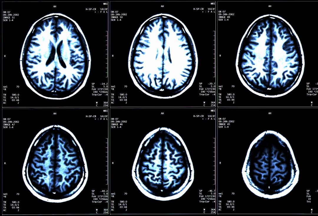 Resonancia magnética de un cerebro. 