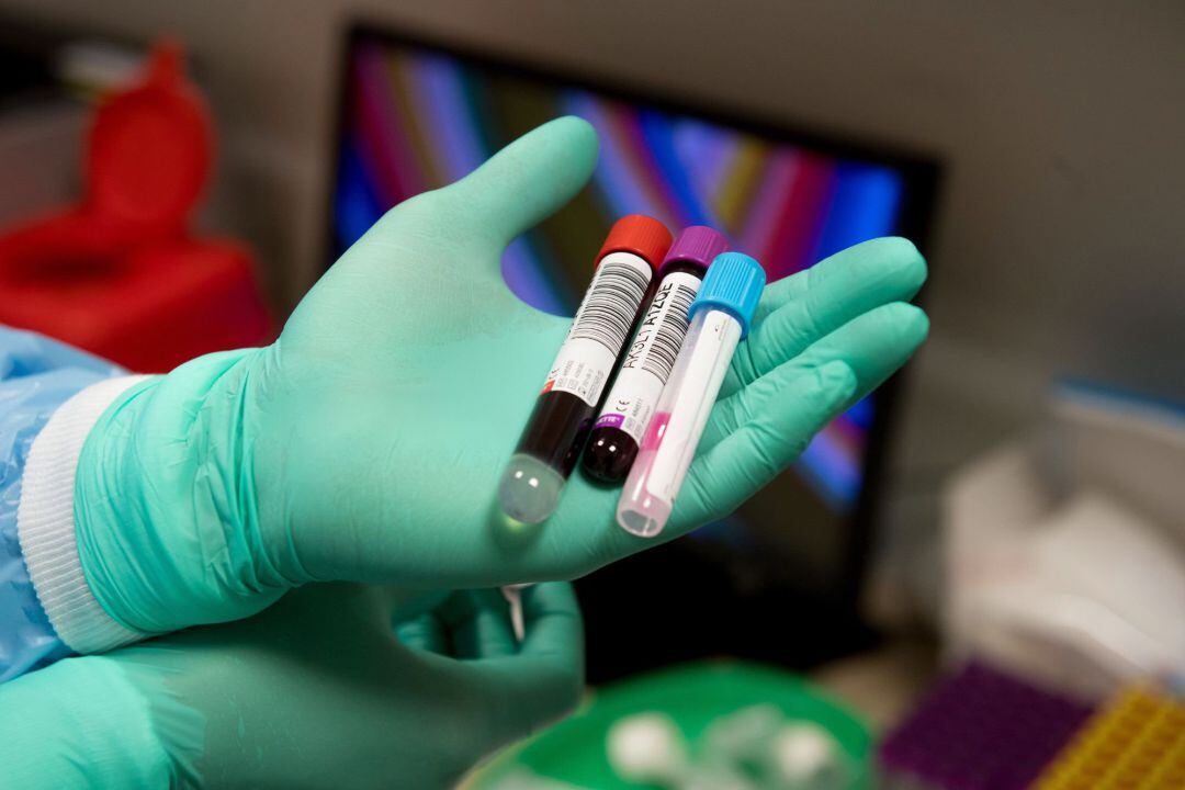 A health worker shows samples to be tested for the novel coronavirus COVID-19 at a clinic of Semmelweis Medical University in Budapest, Hungary