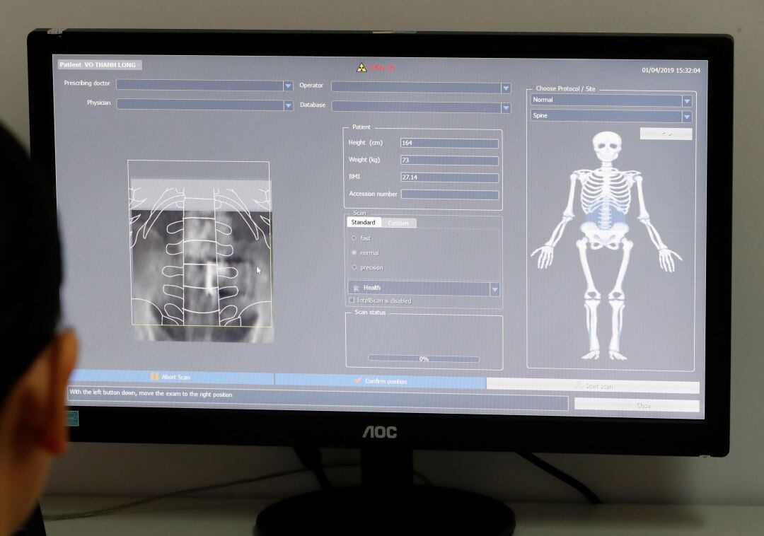 Aplicación médica para detectar la osteoporosis. 