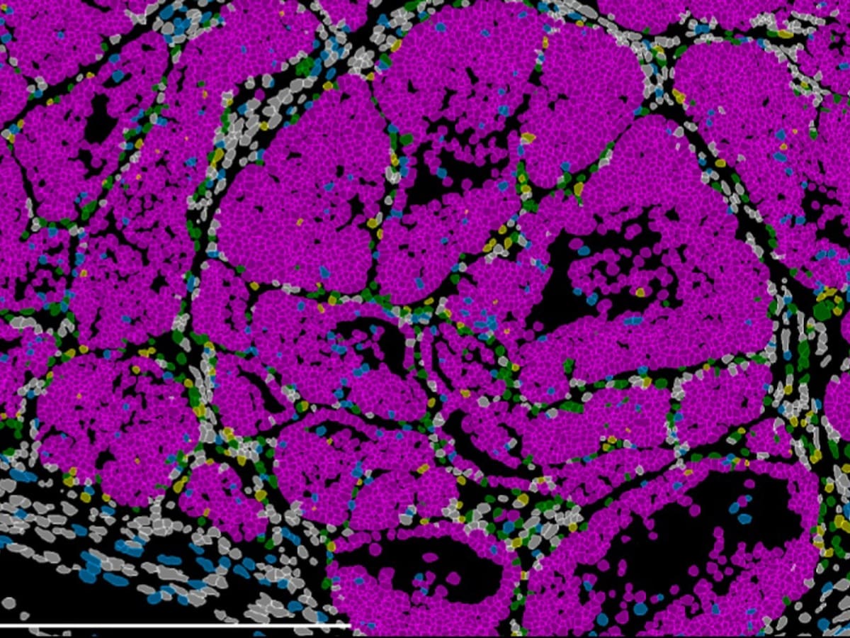 Ángela Nieto, investigadora del CSIC, habla en Hoy por Hoy Alicante del último estudio sobre el cáncer de mama y las células encargadas de la metástasis