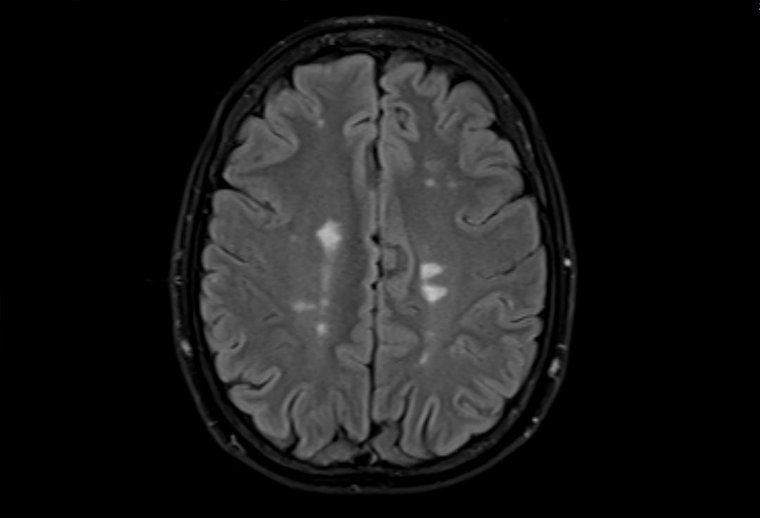 Un cerebro que muestra la esclerosis múltiple.Un estudio señala al virus de la enfermedad del beso como la causa principal.