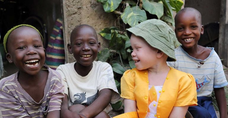 Albinos, el infierno africano de los inocentes