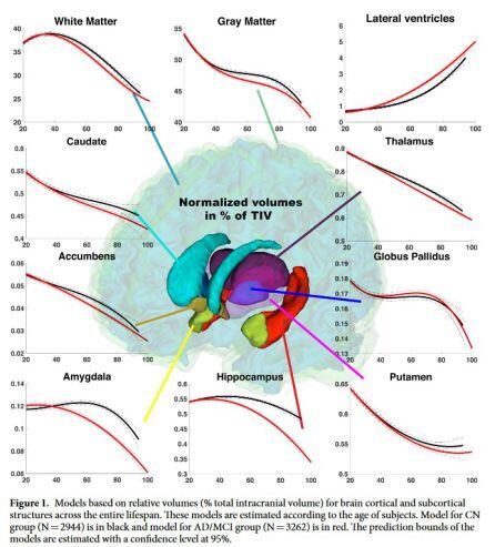 Evolución del alzhéimer en el cerebro