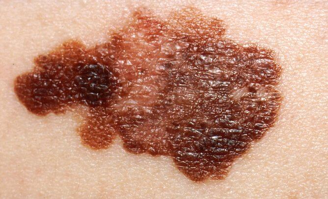 Imatge de melanoma