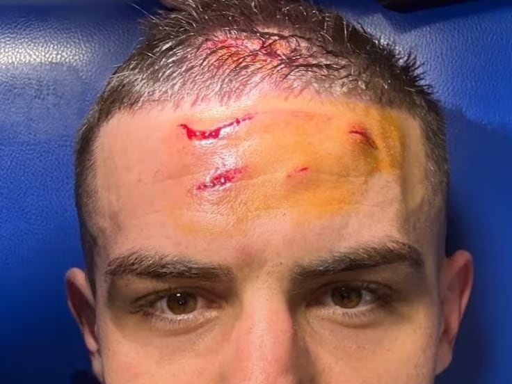 Nikola Krstovic mostrando su herida tras el partido