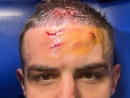 Nikola Krstovic mostrando su herida tras el partido