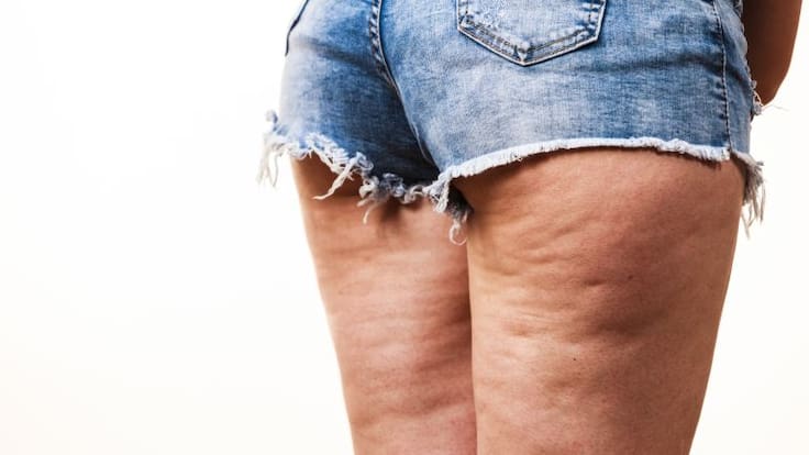 7 claves para evitar la celulitis