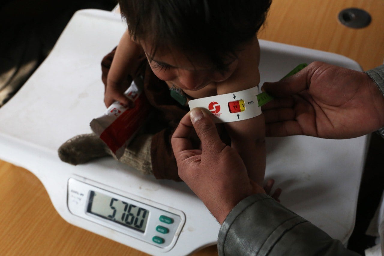 Imagen de archivo de un niño que padece malnutrición en Afganistán