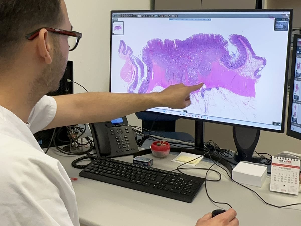 El Mateu Orfila reforça el diagnòstic del càncer implantant la patologia digital