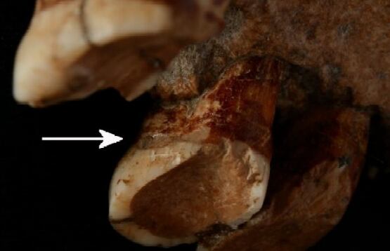 El fósil de diente de Neandertal del yacimiento de Cova Foradà que muestra los surcos causados por el uso del palillo