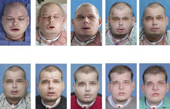 Volunteer firefighter Patrick Hardison, 41, of Senatobia, Mississippi is shown in this series of photos showing the progress of face transplant surgery in this undated handout provided by NYU Langone Medical Center in New York, November 16, 2015. Hardison