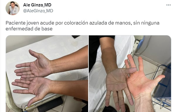 El paciente acudió por la coloración azulada