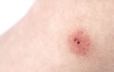 La doble marca que deja la picadura de araña.