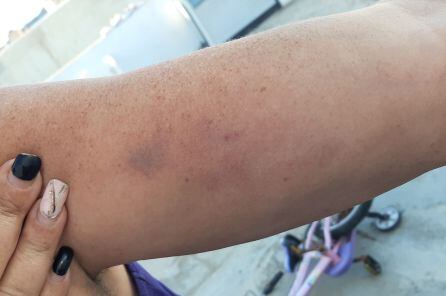 La madre del menor asegura que también tiene moratones al ser agarrada.
