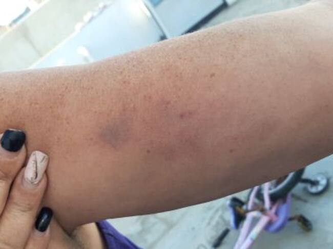 La madre del menor asegura que también tiene moratones al ser agarrada.
