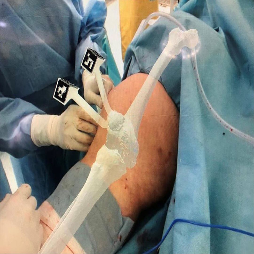 Cirugía asistida con navegador quirúrgico de realidad aumentada