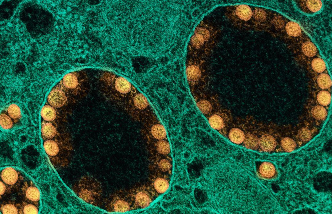 Micrografía electrónica de transmisión de partículas del virus del SARS-CoV-2 (oro) dentro de los endosomas de una célula epitelial olfativa nasal muy infectada.