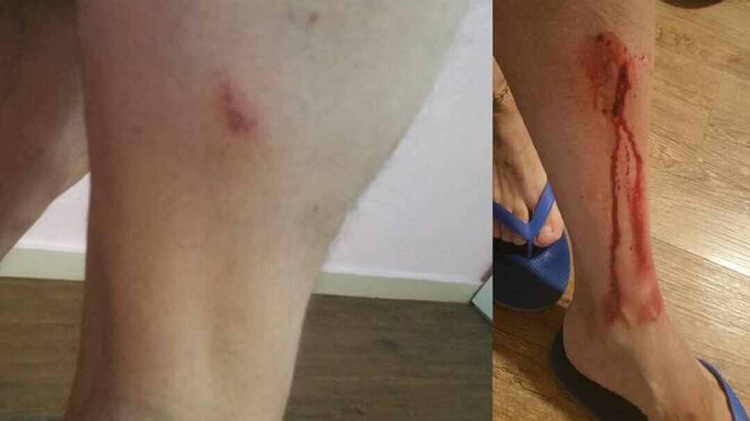 Heridas producidas por el ciclista.