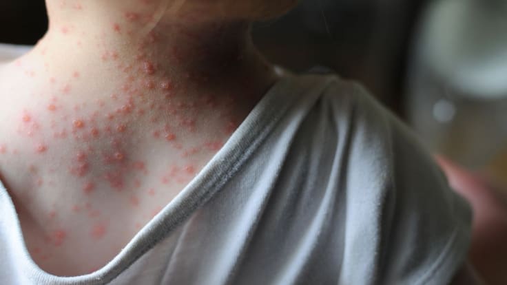 El alicantino Fco Balmis encabezó la primera expedicion de vacunación masiva contra la viruela en Latinoamérica