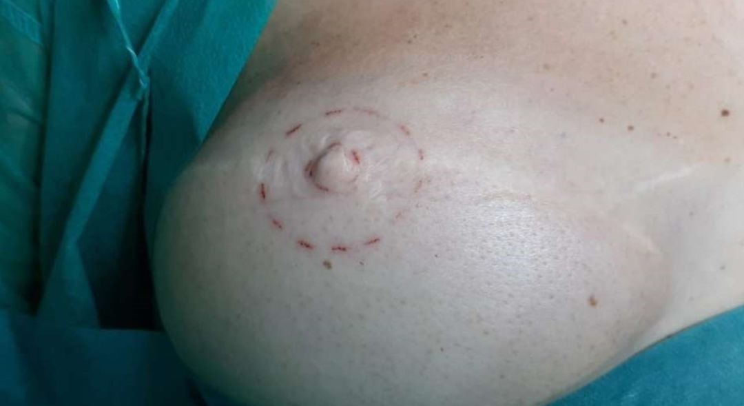 Ejemplo de micropigmentación mamaria  SES