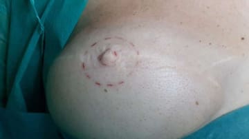 Micropigmentación mamaria