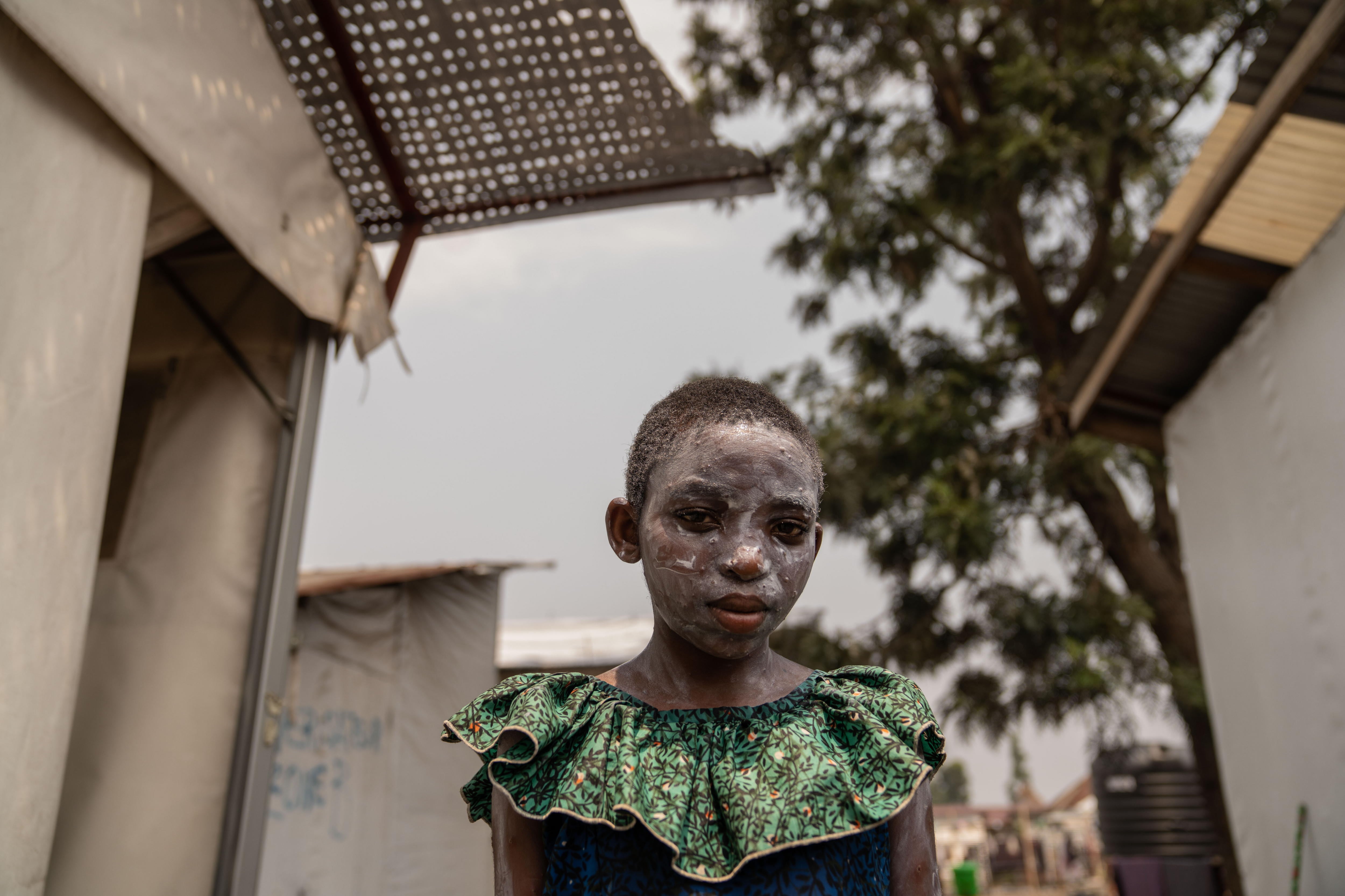 Lucie Habimana, de 13 años, tiene la cara cubierta con ungüento después de recibir tratamiento para el mpox en el Centro de Salud Munigi en Munigi, República Democrática del Congo.