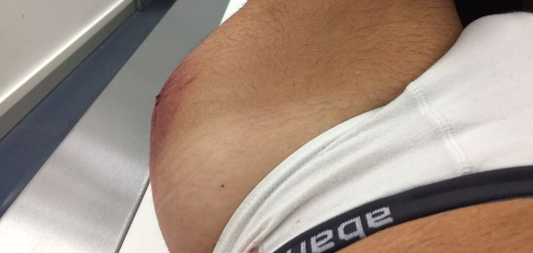 La impactante imagen de la cadera de Luis Moya tras sufrir un accidente en su moto