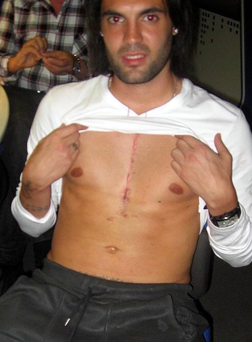 La operación dejó a Sergio Sánchez una gran cicatriz