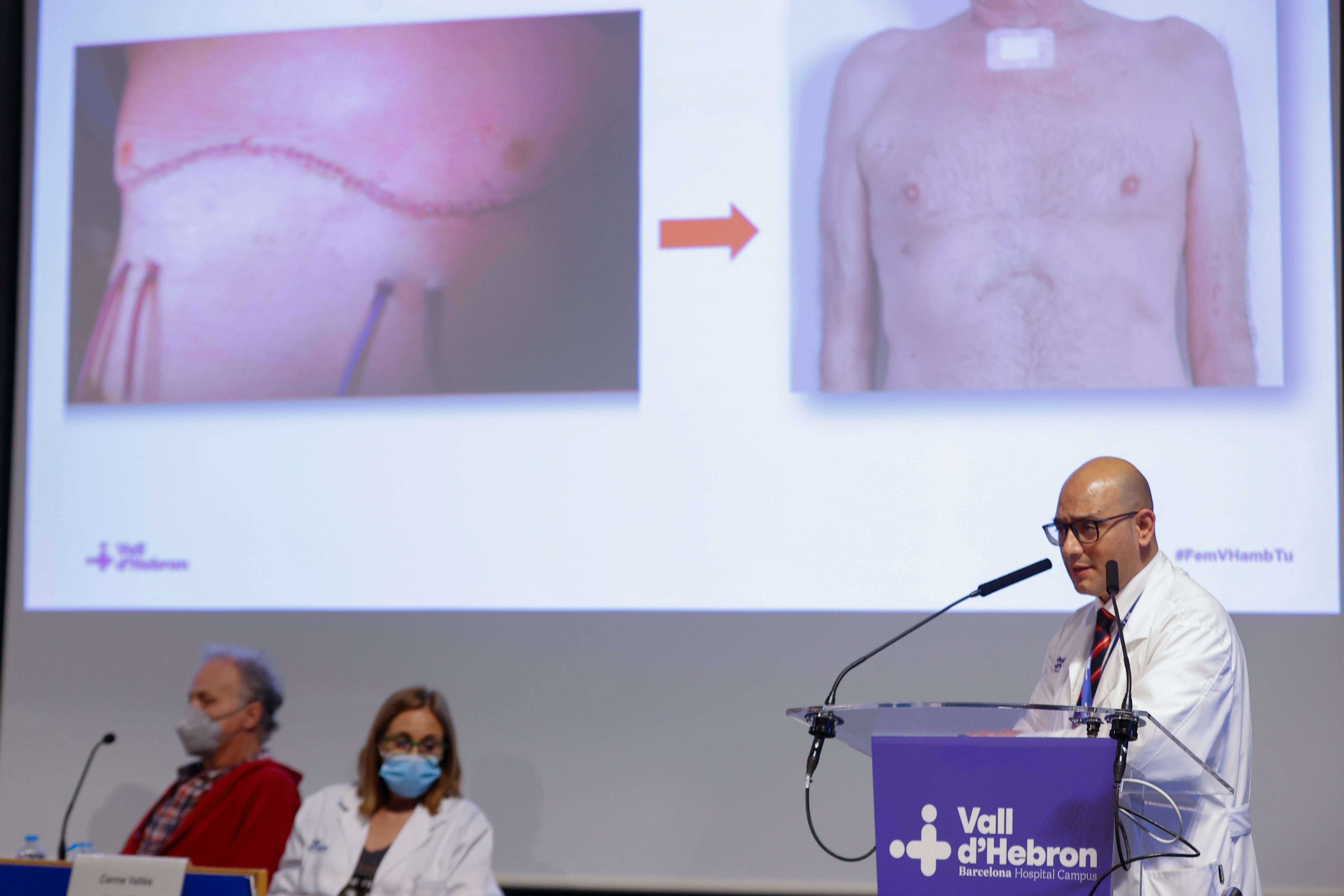 Vall d&#039;Hebrón practica la primera cirurgia de transplantament de pulmó robòtica sense obrir el tòrax