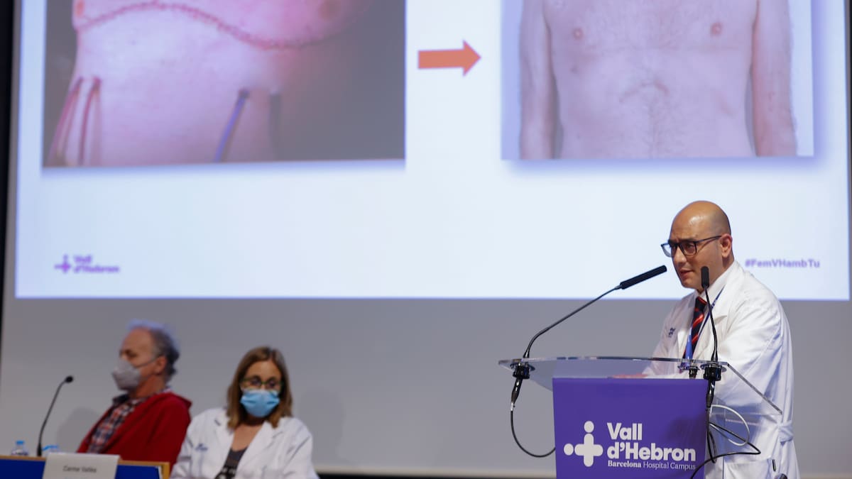 El Hospital de la Vall d'Hebron de Barcelona realiza el primer trasplante de pulmón robótico del mundo sin abrir el tórax