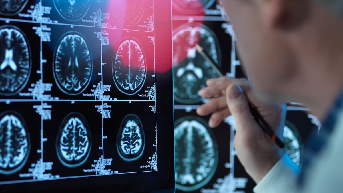 La fluoresceína sódica "delata" las células malignas de las metástasis cerebrales