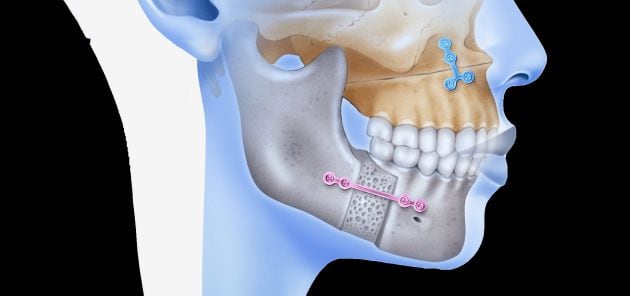 Ejemplos de placas de titanio en la mandíbula